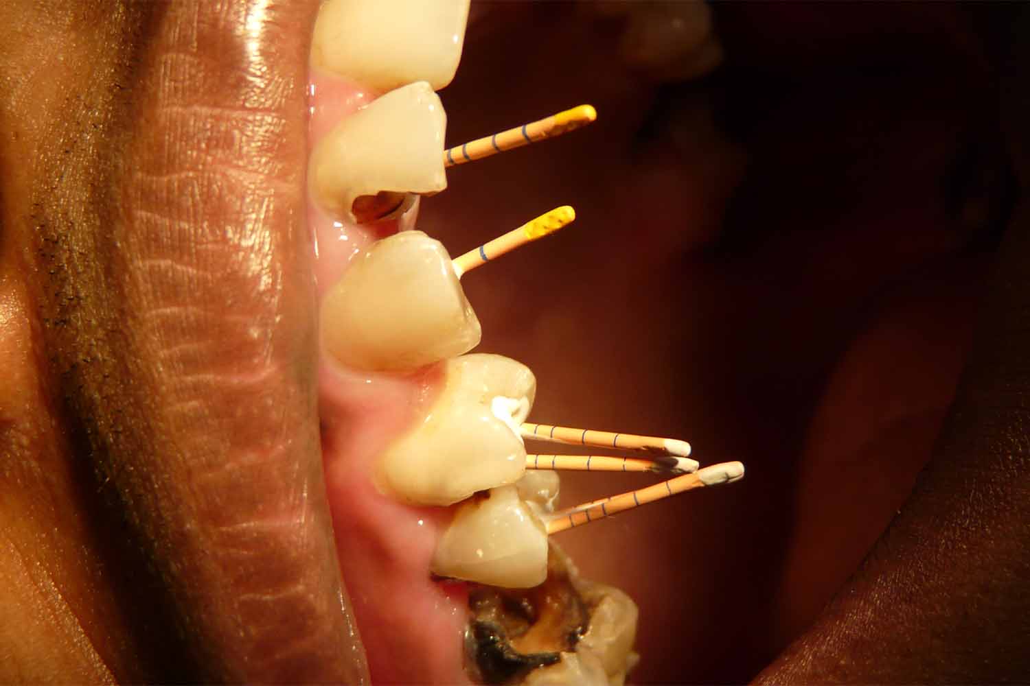 Endodontics