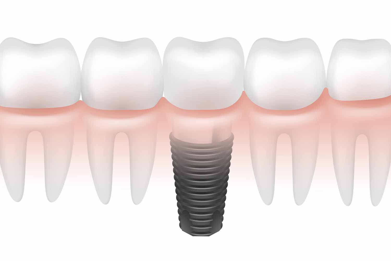 Oral Implantology